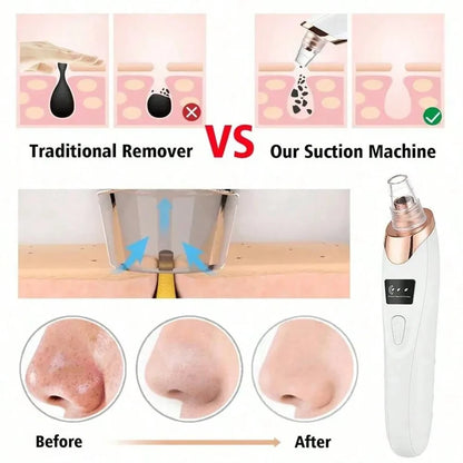 Radiant Glow Blackhead Remover Tool