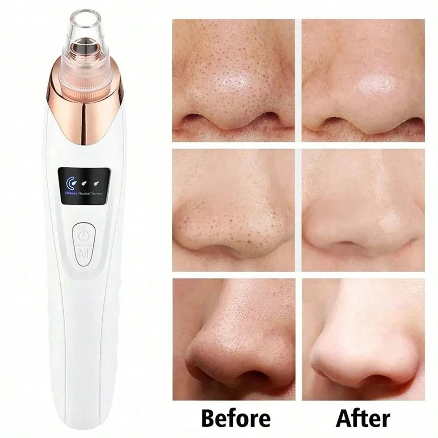 Radiant Glow Blackhead Remover Tool