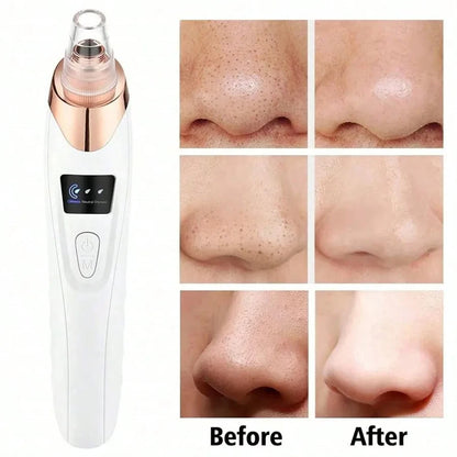 Radiant Glow Blackhead Remover Tool